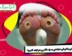 برای زخم پای دیابتی به چه دکتری مراجعه کنیم؟